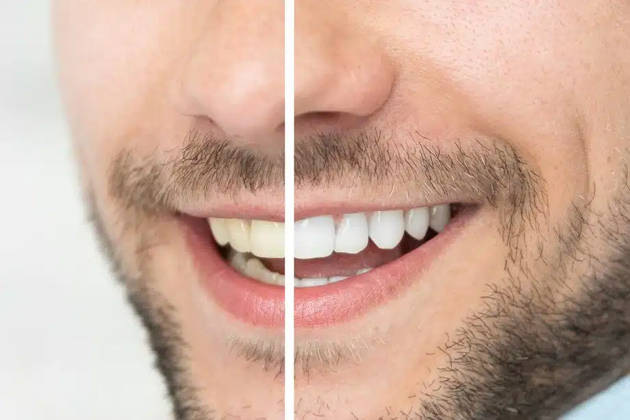 3 Options for Whitening