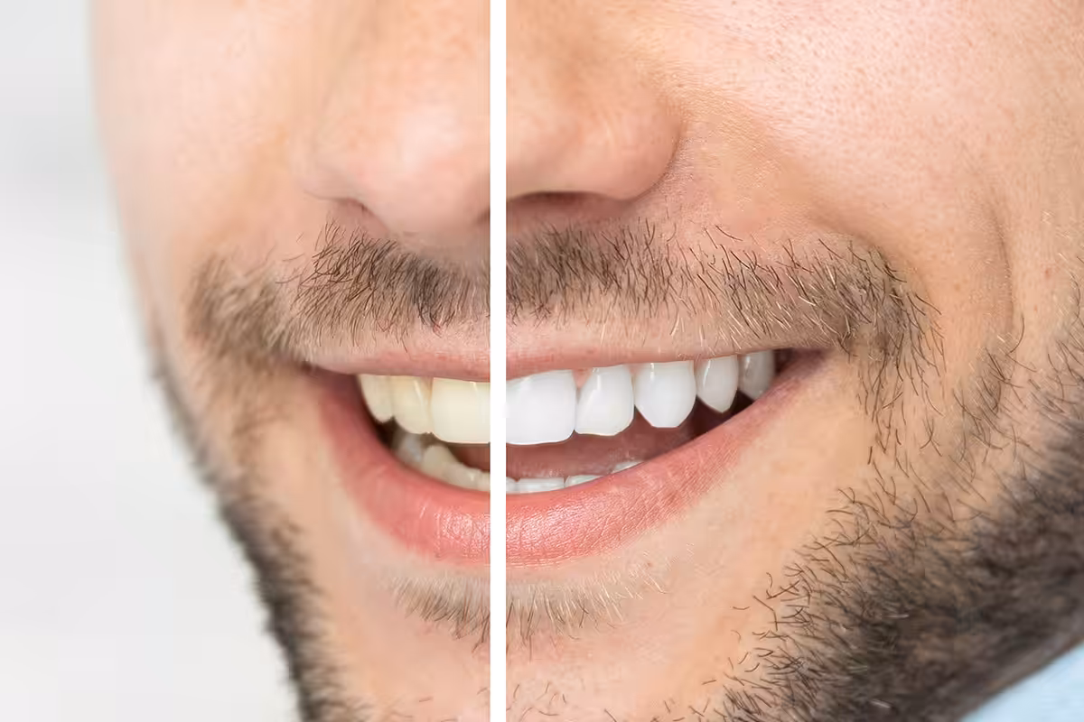 3 Options for Whitening Your Teeth