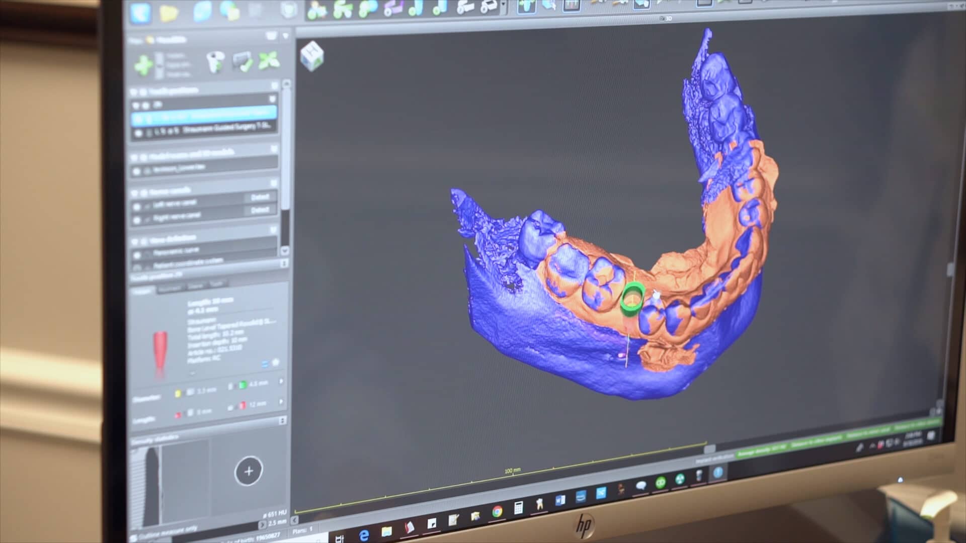 3D Precision Implant Planning Barkoff Dental in Syosset, NY