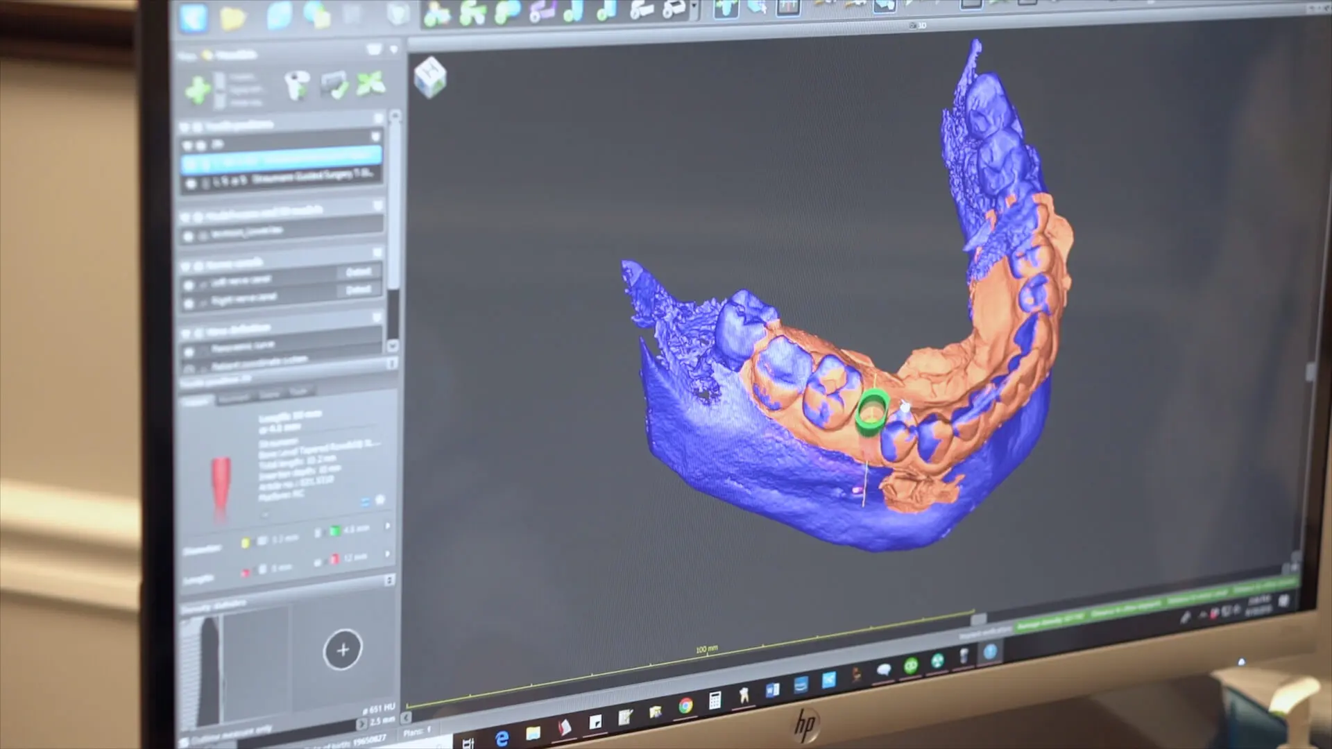 3D Precision Implant Planning