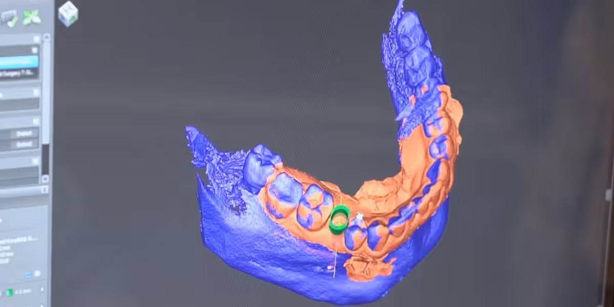 Dental Implants