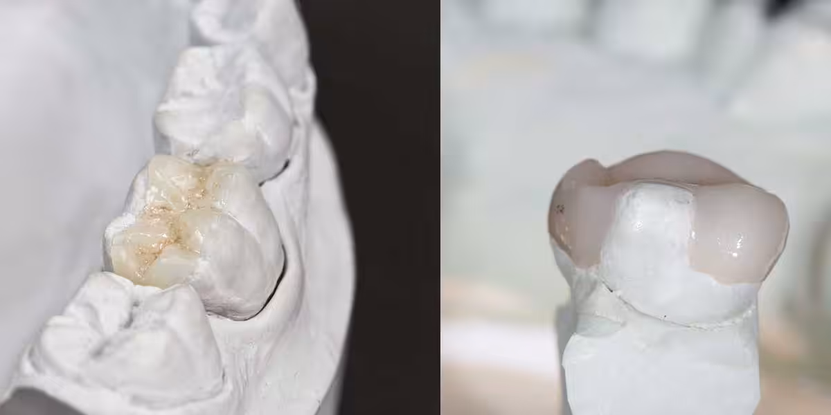 Dental Inlay Dental Onlay