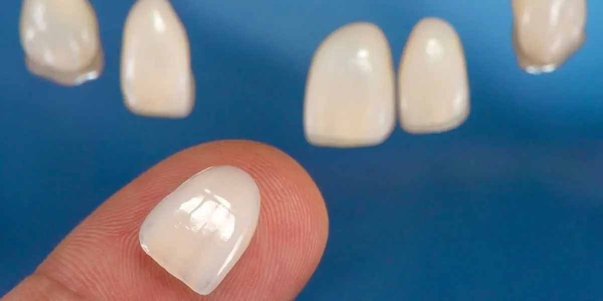 Closeup of Porcelain Veneers