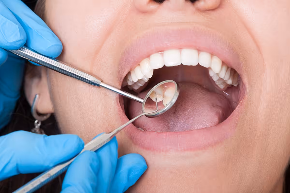 How Much Does A Teeth Cleaning Cost in Nassau County, NY?