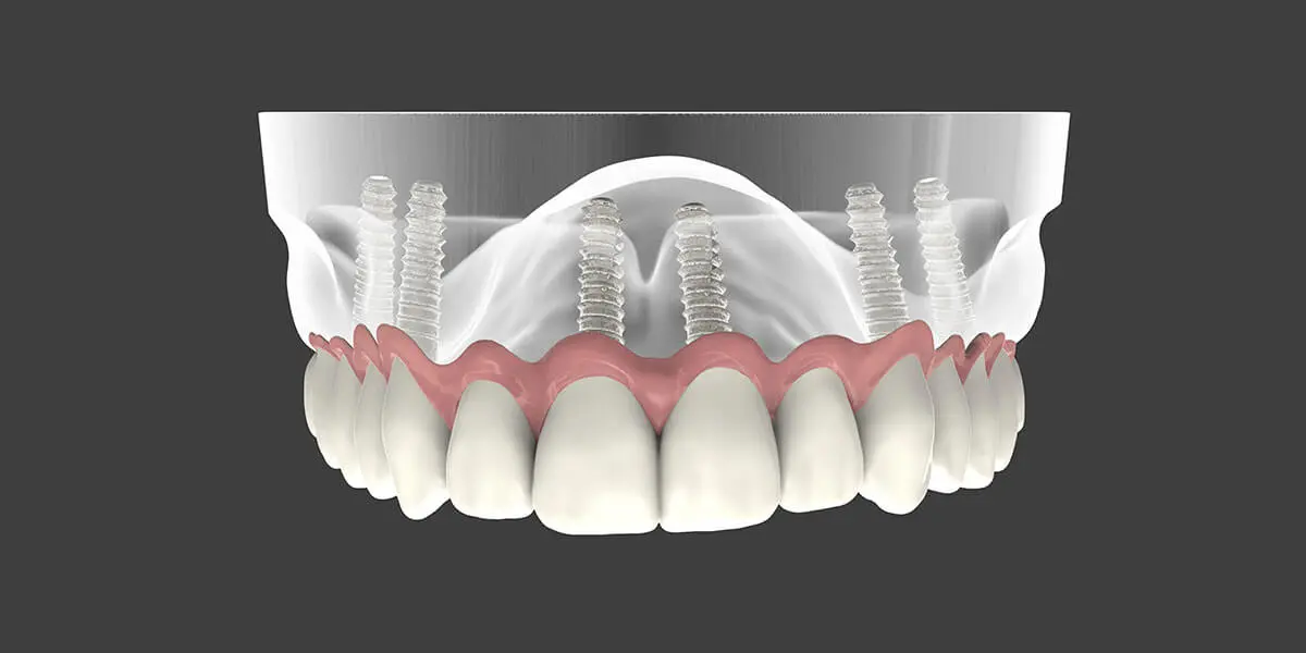 Implant Supported Dentures Graphic