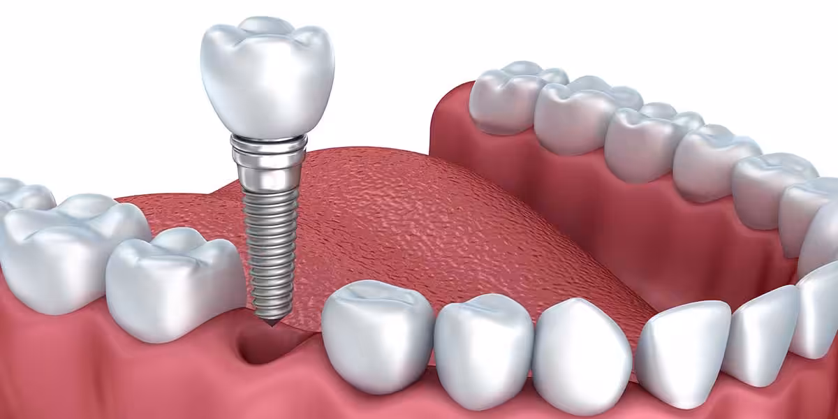 Single Implant Graphic