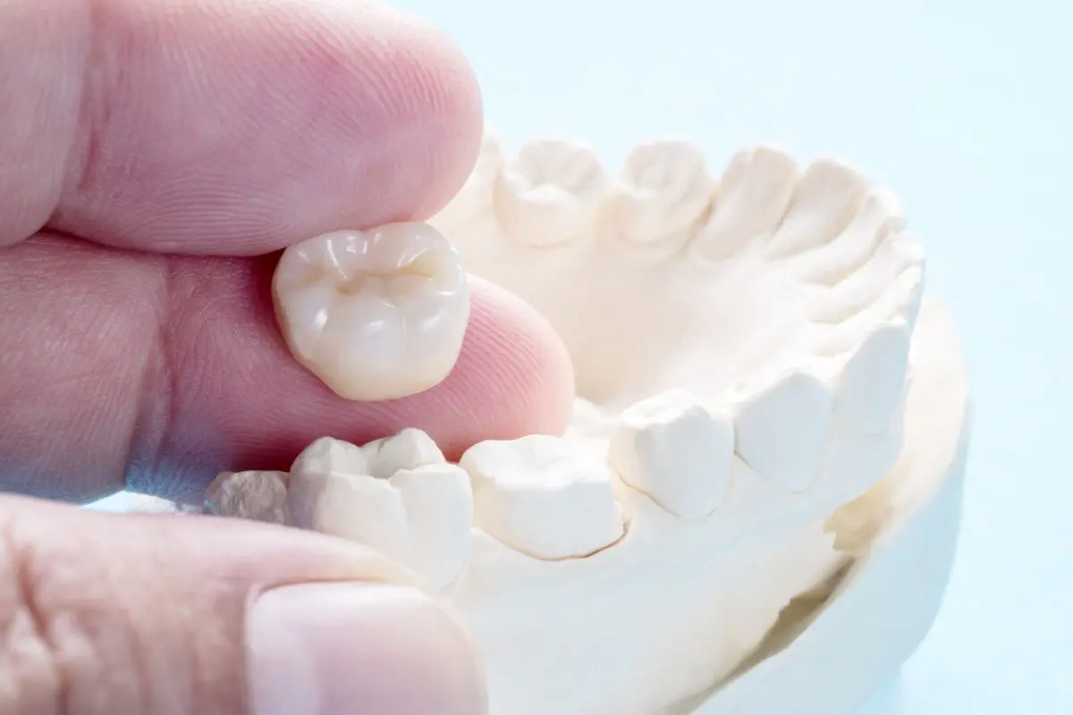 Close Up Of model Of Dental Crown