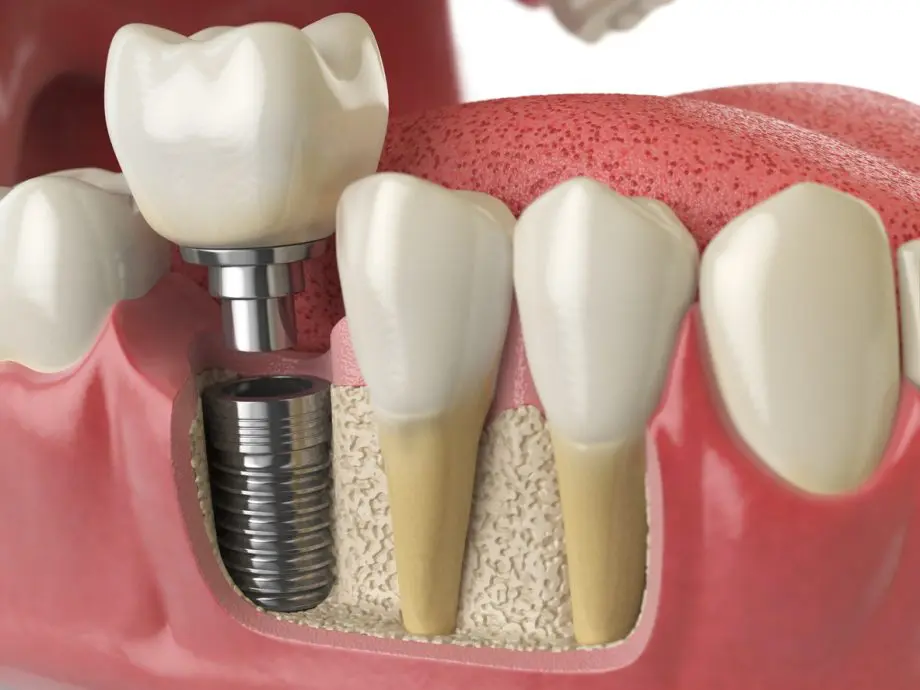 Model Of Dental Implants