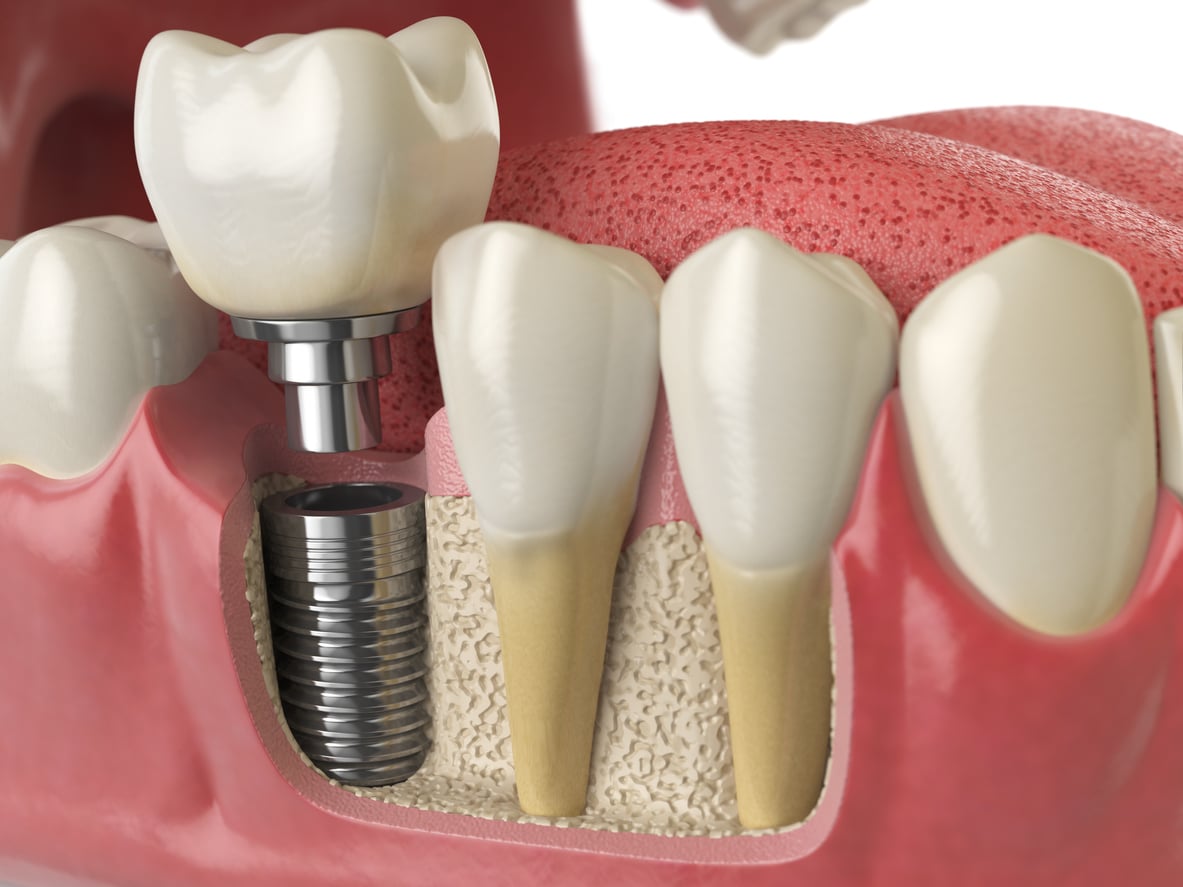 Dental Implants Albany Ny