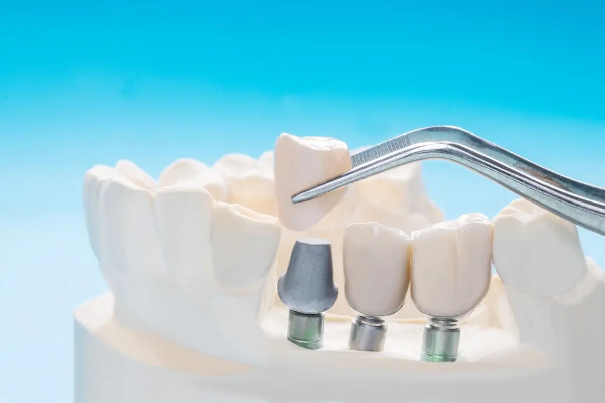 Close Up Model of Dental Implants