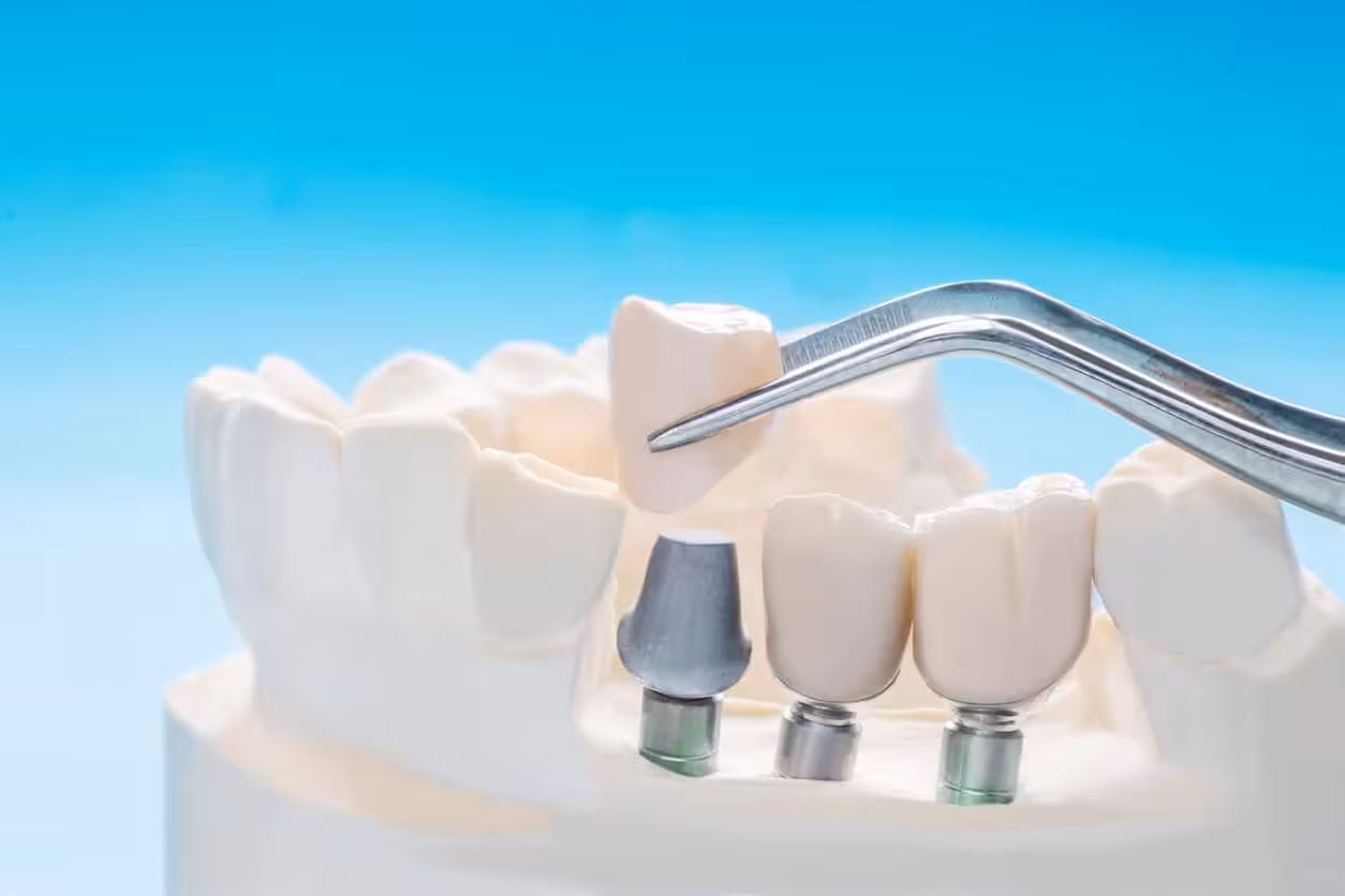 4 Myths About Dental Implants