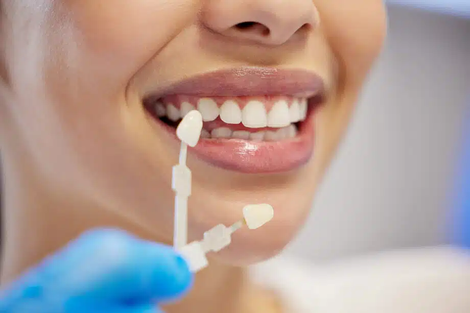 How Long Should Porcelain Veneers Last? A Guide for Syosset Residents