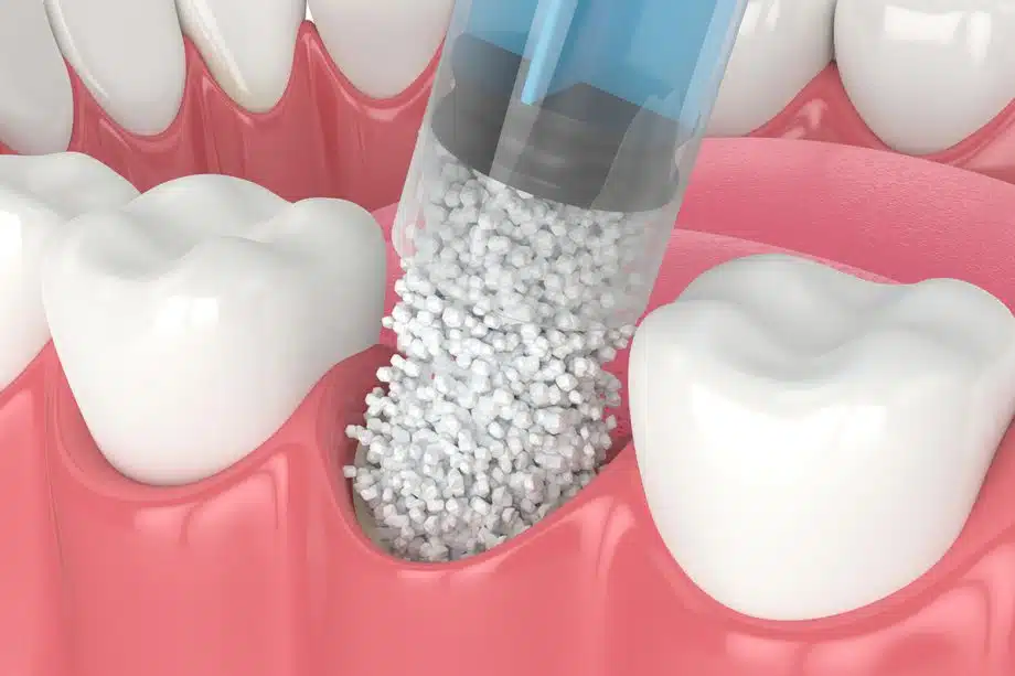 How Much Does Bone Grafting Cost in Nassau County, NY?