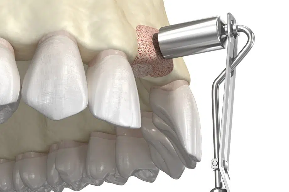 How to Clean the Area After Gum Grafting Surgery
