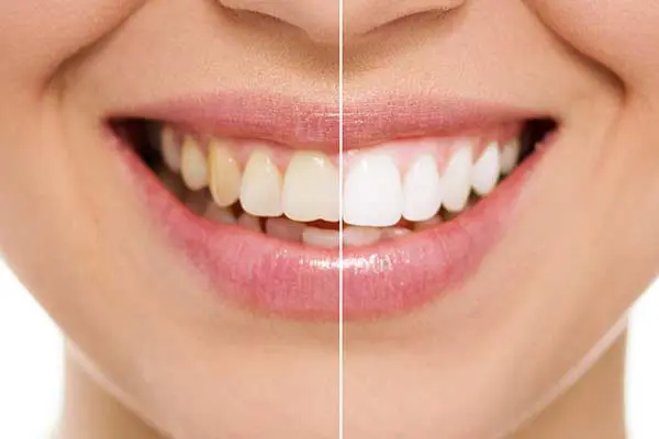 Before and after photo showing teeth whitening