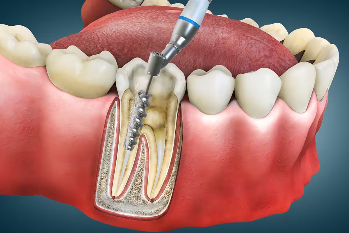 What Can I Eat After A Root Canal?